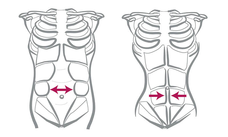 Diástasis abdominal.
